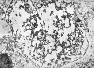M,46y. | Entamoeba histolytica M,46y. | Entamoeba histolytica